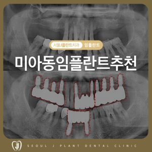 미아동임플란트추천