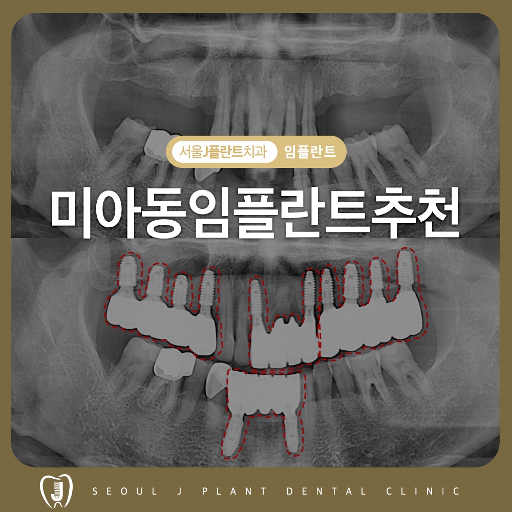 미아동임플란트추천