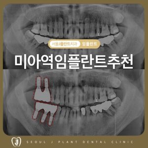 미아역임플란트추천