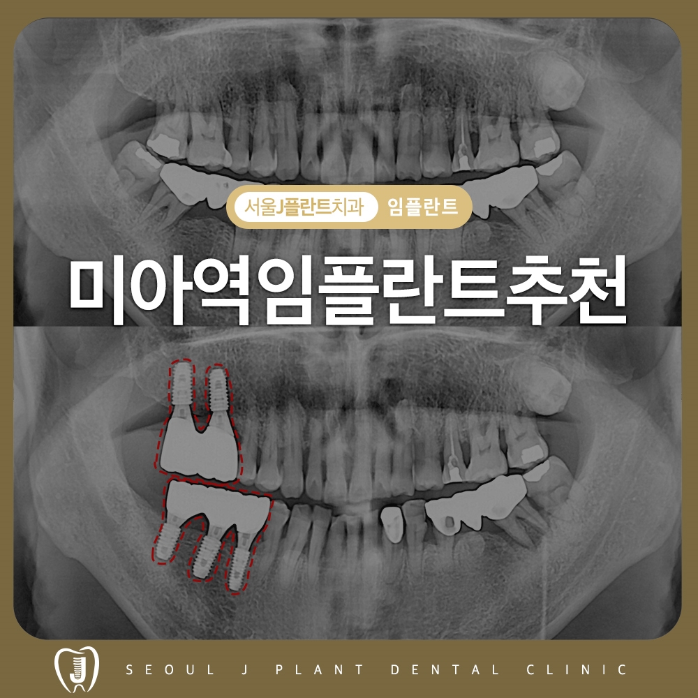 미아역임플란트추천