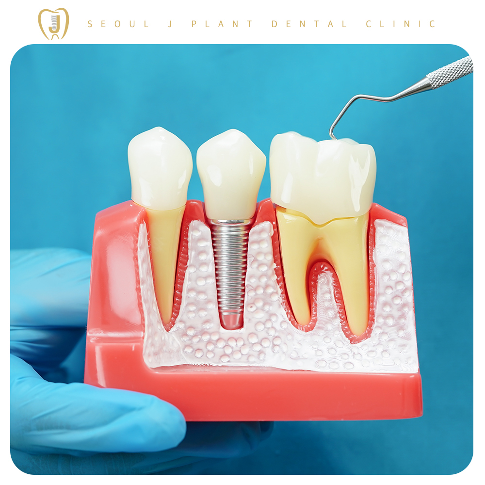 미아동임플란트-서울J플란트치과-임플란트 설명하는 이미지