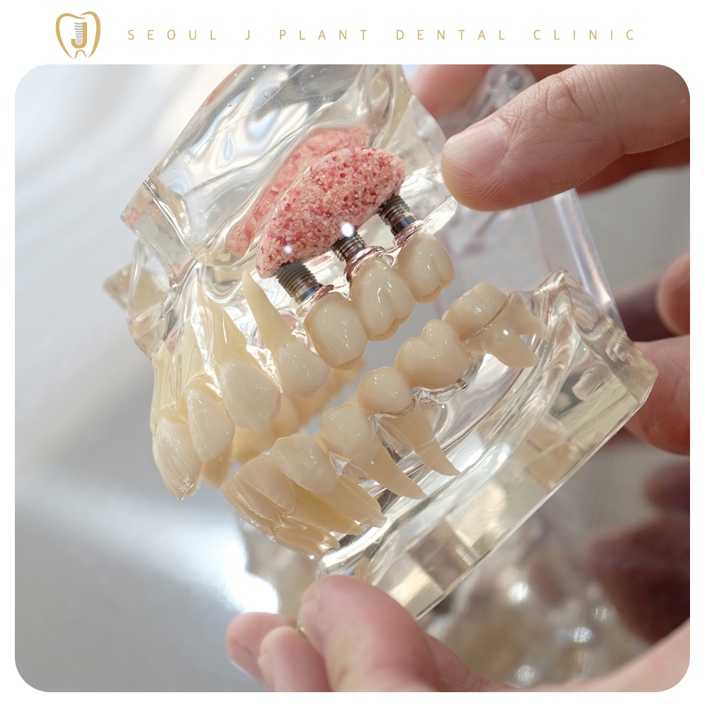 미아동임플란트-서울J플란트치과-임플란트 설명